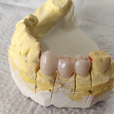 dental crown