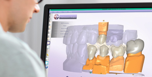 CAD/CAM : Advantages Compared To Traditional Methods - Glorious Dental ...