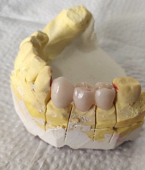 dental crown