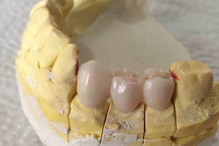dental crown