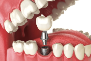 Dental Implant Is Risky