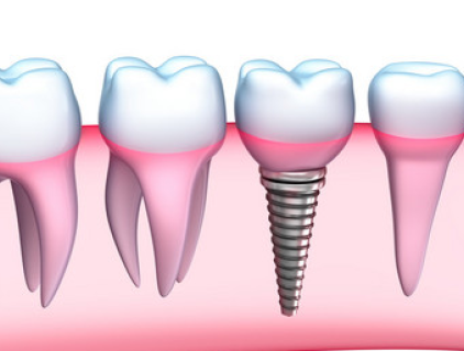 Tandheelkundige impalnt